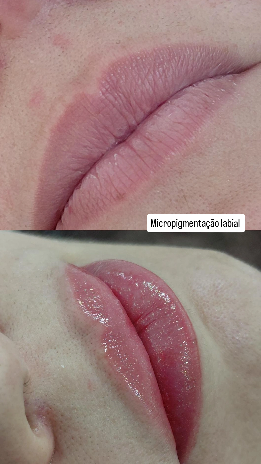 Revitalização labial